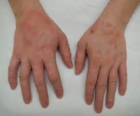 Dermatitis - Wikiwand