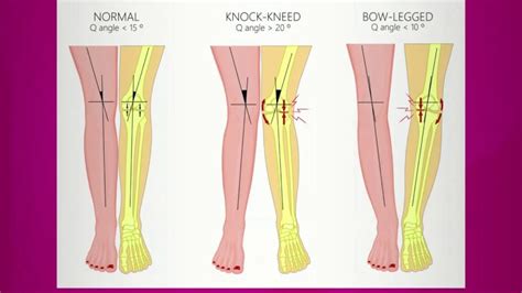 Bow legs and Knock knee - ChildOrthoCare