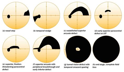 Primary Open-Angle Glaucoma | Clinical Features | Geeky Medics