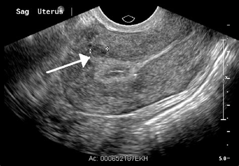 Intramural Fibroid Ultrasound