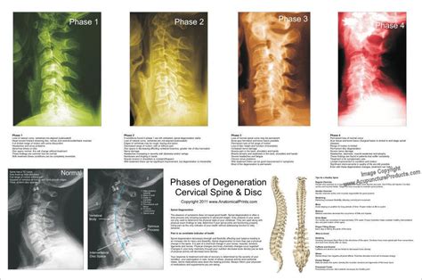 Phases Spinal Degeneration Cervical Spine Poster 24 X 36 Chiropractic Chart