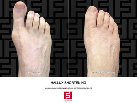 Can you Shorten the Big Toe? — Foot First Podiatry Centers