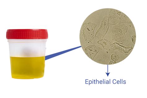 What Epithelial Cells in urine Can Tell You