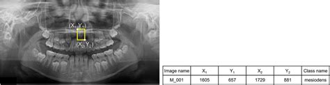 The oral radiologist annotated the mesiodens with a yellow rectangular ...