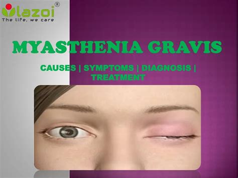 PPT - Myasthenia Gravis: Symptoms, Causes, diagnosis and treatment. PowerPoint Presentation - ID ...