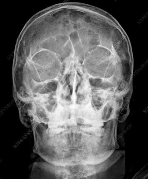 Skull with multiple myeloma, X-ray - Stock Image - F035/6018 - Science Photo Library