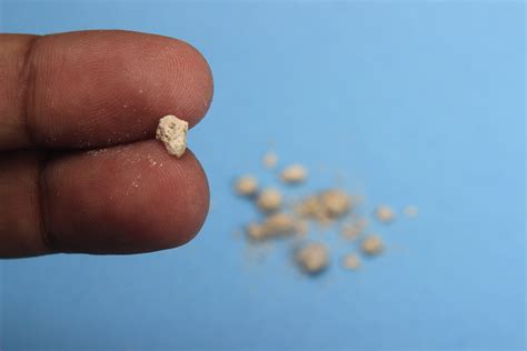 Kidney Stones: More Common Than You May Think - Urology Austin