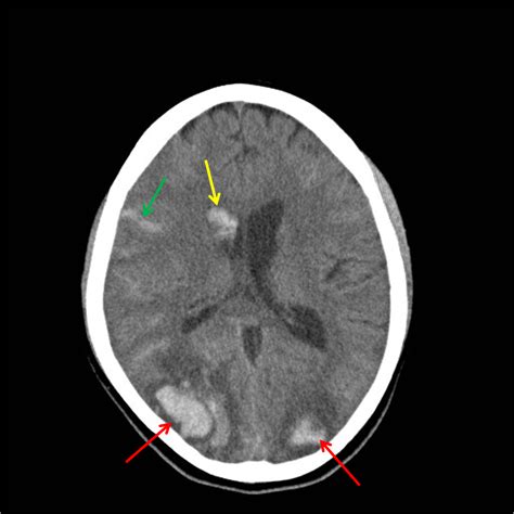 Non-Traumatic Intracranial (Intracerebral) Hemorrhage – Differential ...