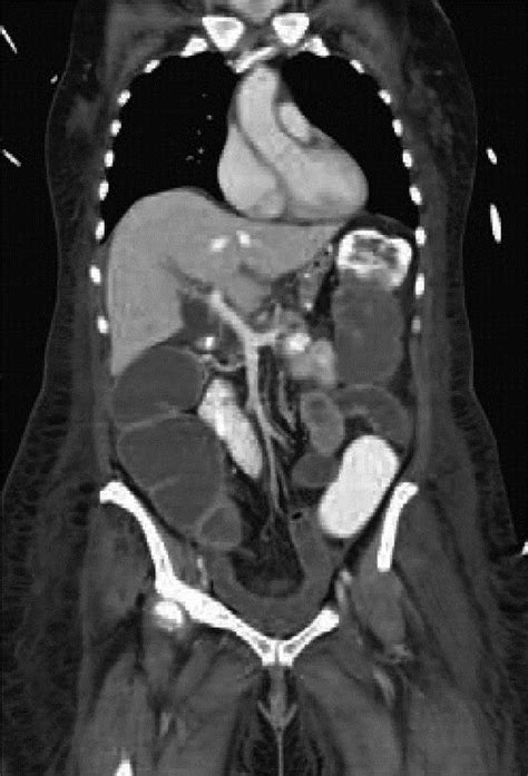 CT scan of abdomen without visible calcification of the mesenteric vein ...