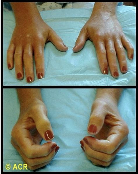 SCLERODERMA - Precision Rheumatology