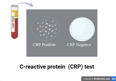 C-reactive protein (CRP) Test: Principle, Procedure, Result • Microbe ...