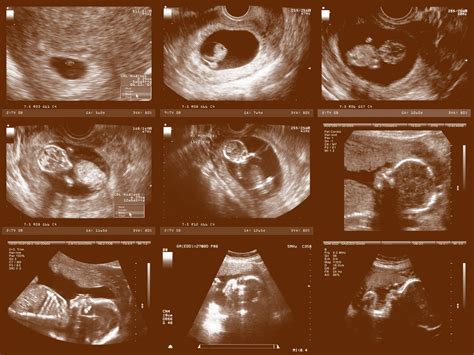 Pregnancy Ultrasounds Week by Week