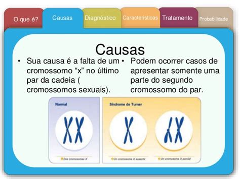 Síndrome de turner - Causas, sintomas e tratamento | Atual FM