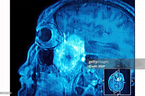 Intercranial neurinoma, seen on a sagittal section MRI scan. News Photo ...