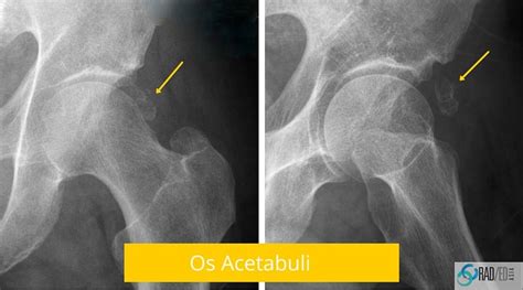 Hip MRI ? Show me the Xray: Acetabular Rim Ossifications. How to make ...