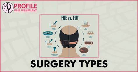 Surgery Types