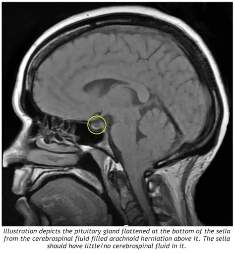 Mengenal Lebih Dekat: Apa itu Empty Sella Syndrome - Read More