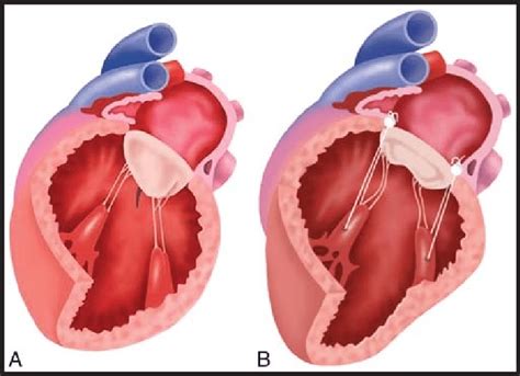 A and B, Placement of papillary muscle realignment sutures through the... | Download Scientific ...