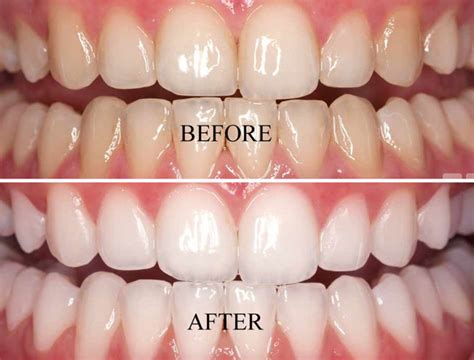 Teeth Whitening Treatment Indore | Bhardwaj Dental Clinic