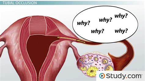 Female Sterilization Procedures: Tubal Ligation and Tubal Occlusion - Video & Lesson Transcript ...