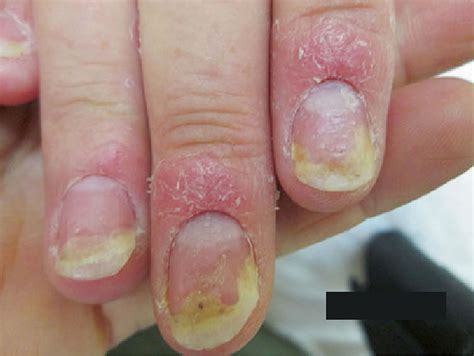 Nail psoriasis causes, symptoms, diagnosis, treatment & prognosis