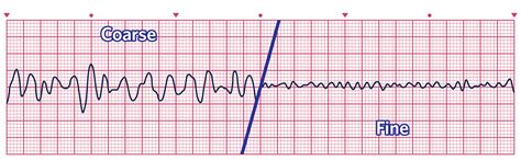 Coarse Ventricular Tachycardia