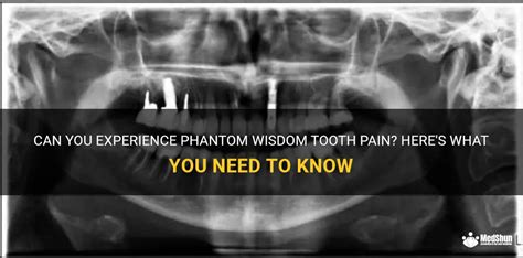 Can You Experience Phantom Wisdom Tooth Pain? Here's What You Need To ...