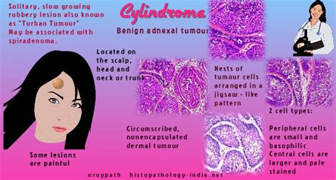 Pathology of Cylindroma - Dr Sampurna Roy MD