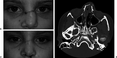 The patient is a young female who suffered a blow to the nasal dorsum.... | Download Scientific ...