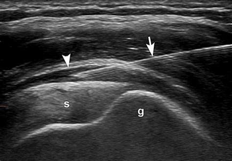 Hip Bursitis Ultrasound