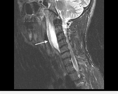 Magnetic resonance imaging (MRI) of soft tissues of the neck showing a... | Download Scientific ...