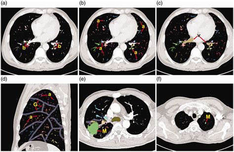 Radiopaedia Lung Segments