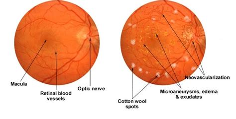 diabetic retinopathy screening and treatment — Downtown Eyecare and Optical