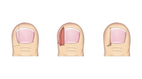 Ingrown Toenail Management – The Podiatric Method | Lower Limb Specialist Centre