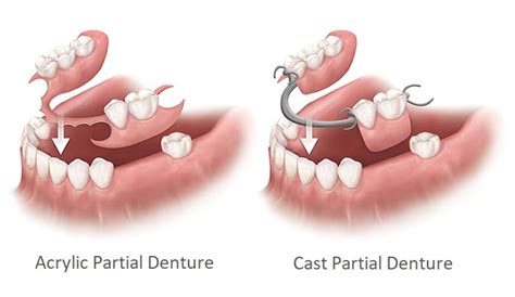 Partial Denture Clinic in Airdrie - Woodside Denture Centre