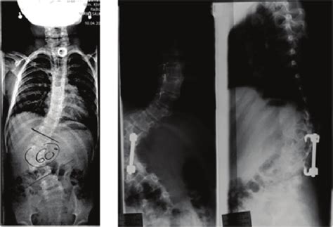 Progression after early operation for severe hemivertebra at the age of ...