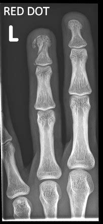 Distal Phalanx Fracture