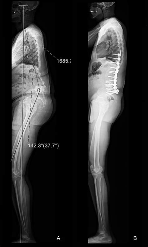 Lordosis Treatment Before After