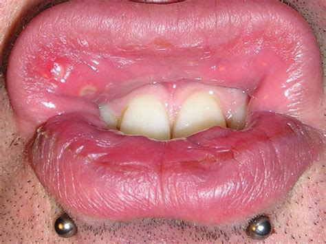 Mouth Ulcers: Causes, Symptoms, Treatment & Prevention - Boldsky.com