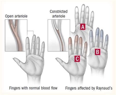 Cold hands: Could it be Raynaud’s? - Harvard Health | Raynauds, Raynaud ...