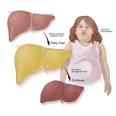 7 Ways To Spot Liver Failure