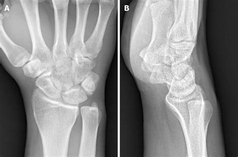 Triquetral Fracture Symptoms