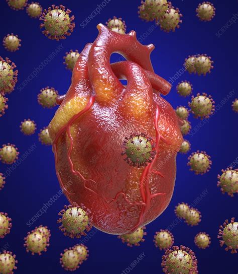 Heart inflammation in Covid-19, conceptual illustration - Stock Image - C050/8657 - Science ...