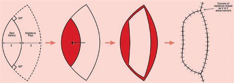 Design of a keystone fasciocutaneous advancement flap. | Download Scientific Diagram