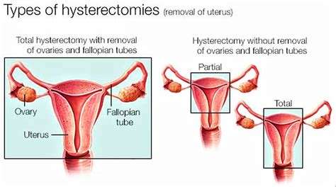 Hysterectomy reasons, types of hysterectomy & hysterectomy side effects