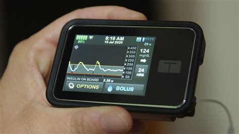 Insulin Pump and Continuous Glucose Monitor - HubPages