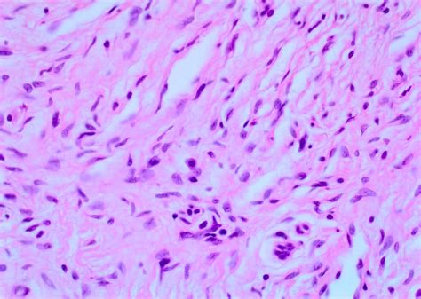 Neurofibroma Histology