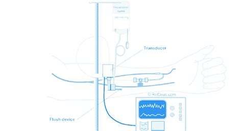 Radial arterial line and transducer [36]. | Download Scientific Diagram