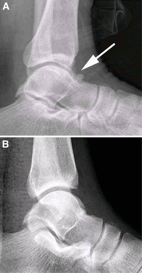 Arthroscopic debridement of anterior ankle impingement in patients with ...