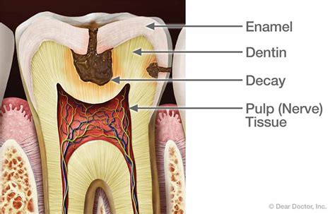 Tooth Pain | Dental Innovations | Mark D. Shirley, DDS | Oklahoma City ...